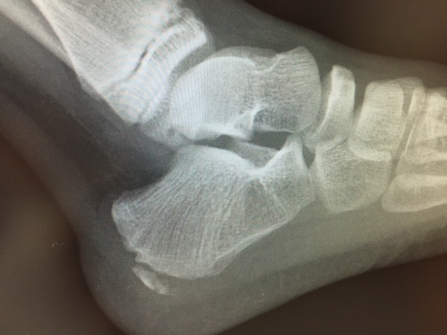 セーバー病(Sever disease) Shockwave治療 | 安土整形外科医院