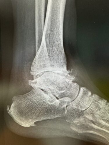 人工足関節置換術 (Total ankle arthroplasty) | 安土整形外科医院