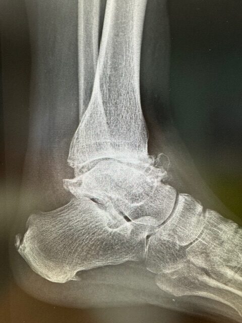 人工足関節置換術 (Total ankle arthroplasty) | 安土整形外科医院 人工足関節置換術 (Total ankle arthroplasty) | 安土整形外科医院